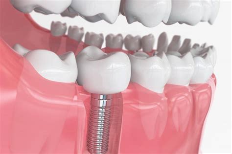  NanoHydroxyapatite Pour Les Implants Dentaires: Un Matériau Biocompatible et Osseo-Intégratif!